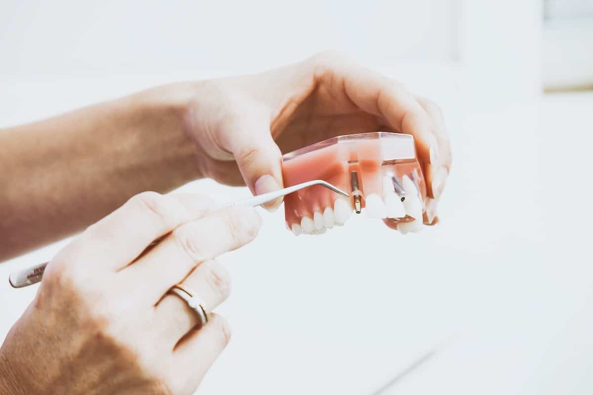 Learn About Different Stages of Dental Implants