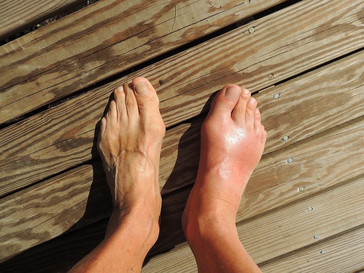 The Primary Causes of Edema and How to Treat It