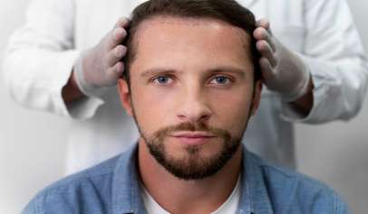 Hair Transplant