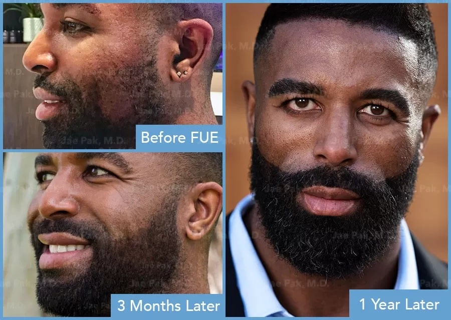 1. Jae Pak MD_ Help the Groom Look His Best Day With Beard Transplants