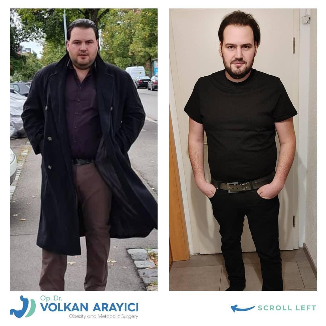 gastric sleeve turkey