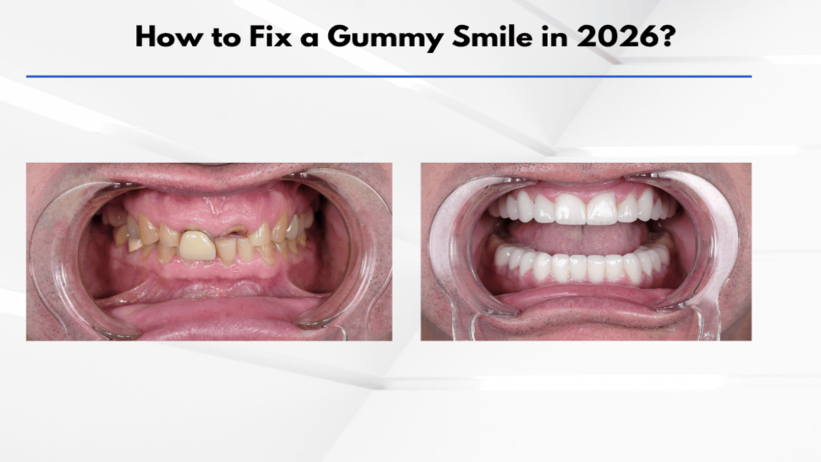 gummy smile