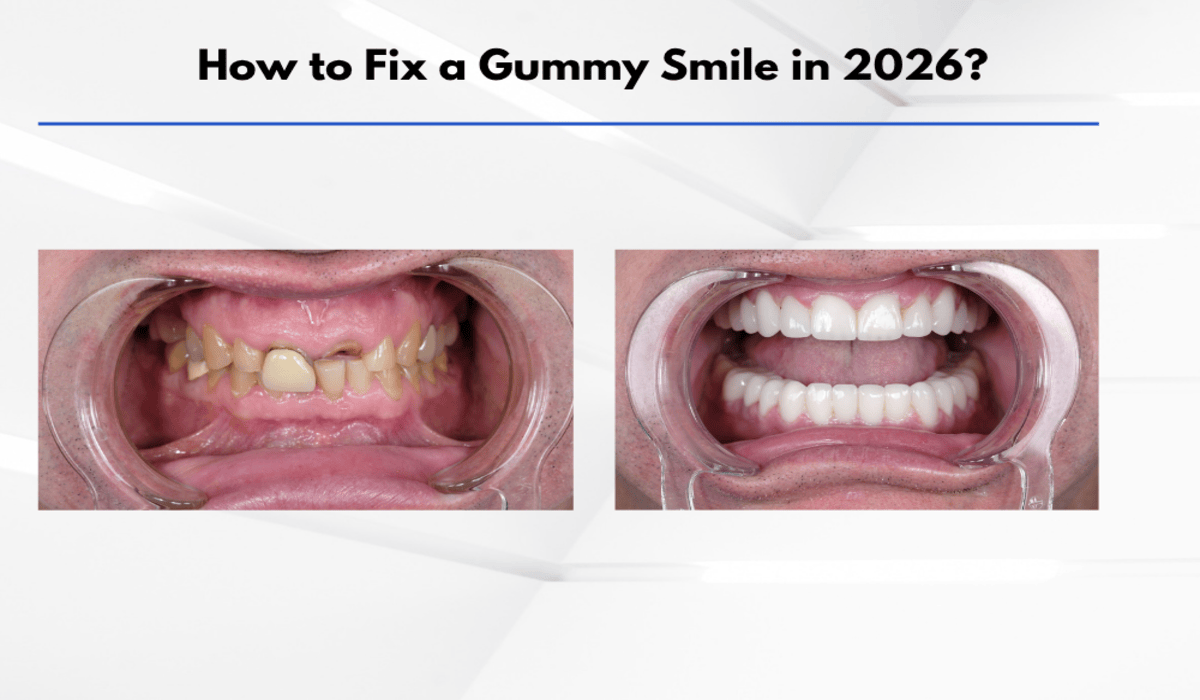 gummy smile